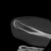 SPORK, NICO - 22.03.1976 - 02.08.2022 - CT obere Extremität - 17:59:38